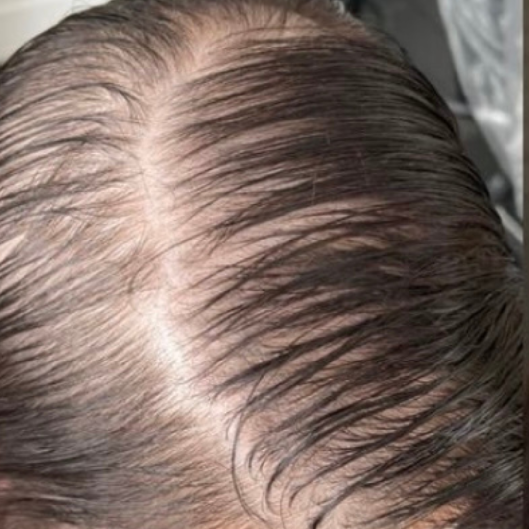 SKN Deep Cosmetic Clinic - Scalp Micropigmentation Before - Grimsby Ontario - 1080 x 1080